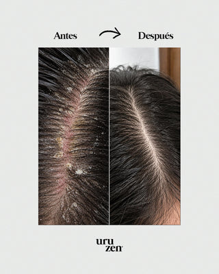 Tónico Natural Uruzen · Purifica y equilibra el microbioma capilar · Cuero cabelludo en paz